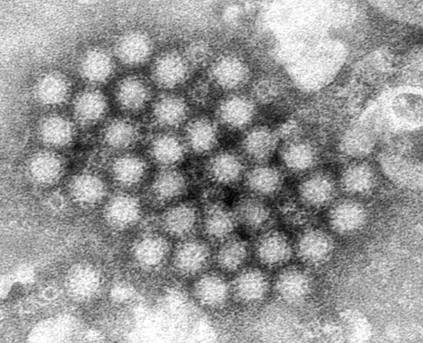 Norovirus cases are surging around the US and 40% above highs for this time of year