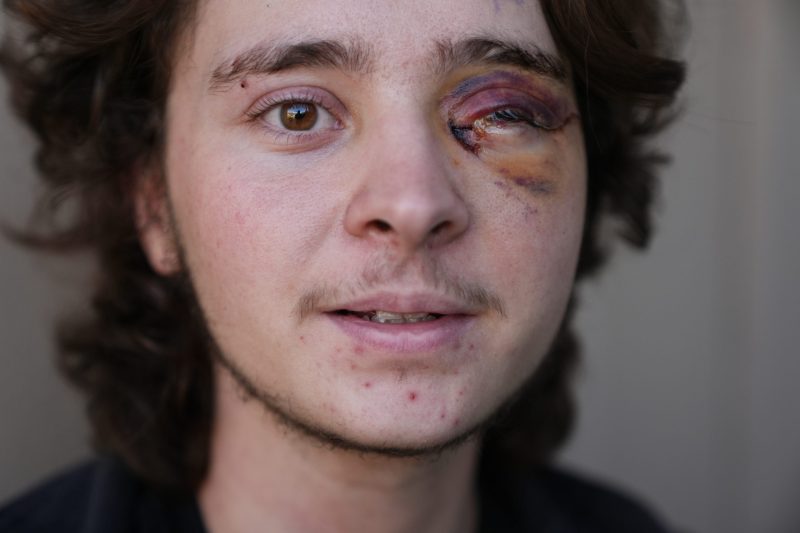 See the face of ICE’s crackdown on normal Americans: a 21-year-old college student permanently blind in one eye