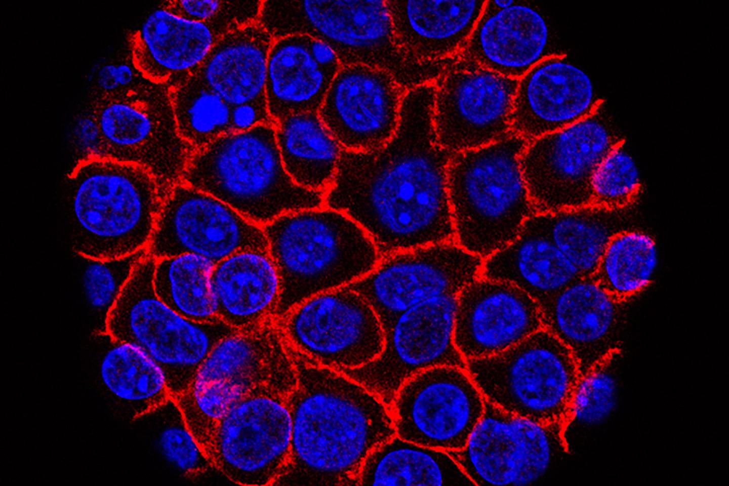 Experimental pill nearly doubles survival time for people with advanced pancreatic cancer. ‘I actually started crying’