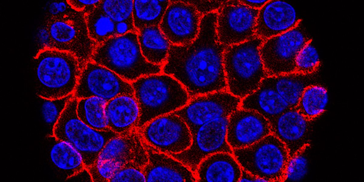 Experimental pill nearly doubles survival time for people with advanced pancreatic cancer. ‘I actually started crying’ Experimental pill nearly doubles survival time for people with advanced pancreatic cancer. ‘I actually started crying’