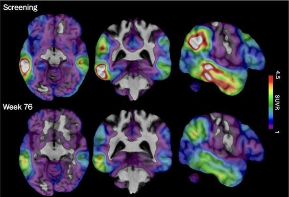 New experimental Alzheimer’s drug shows potential after study shows slower cognitive decline