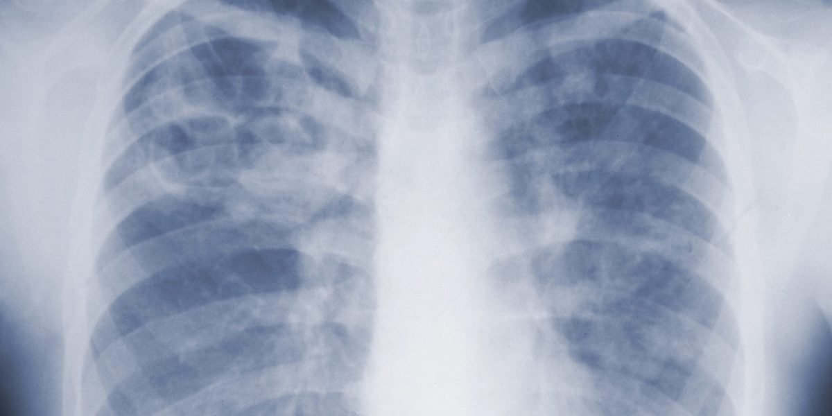 ‘Kind of the first time we’ve had an estimate like this’: first CDC study on mold finds it’s much deadlier than we thought - Fortune