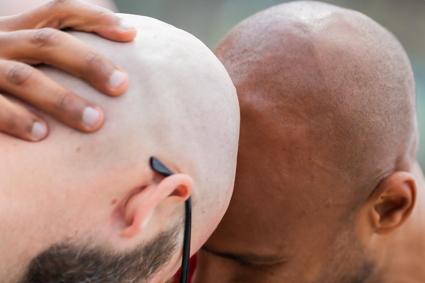 Forget GLP-1 stocks, baldness drugs are Wall Street’s next goldmine