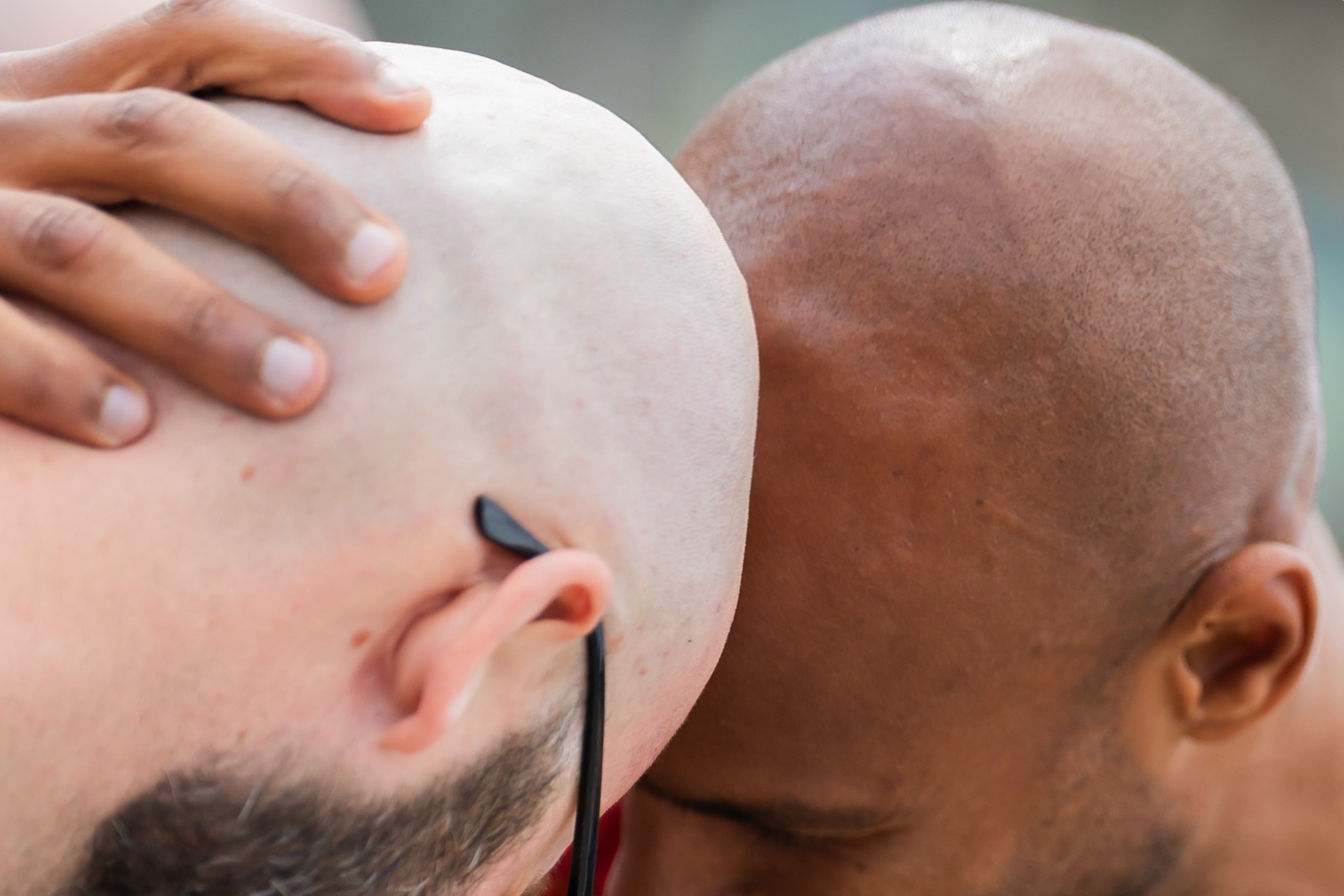Forget GLP-1 stocks, baldness drugs are Wall Street’s next goldmine