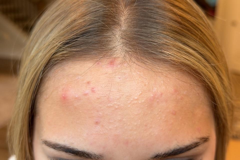 Our tester with acne-prone skin