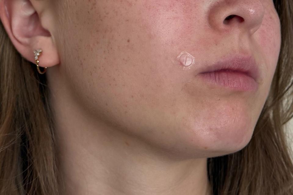Our tester with the best pimple patches