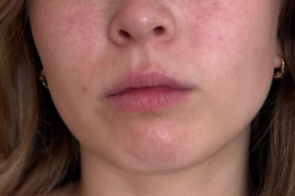 Our tester with the best pimple patches